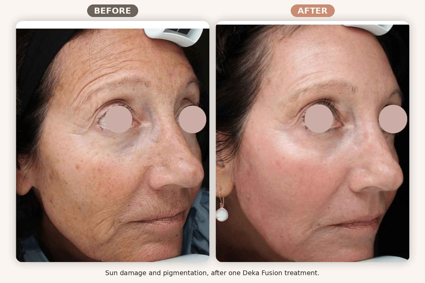 Deka Fusion before and after sun damage and pigmentation, one treatment, Renew MedSpa Eagan MN