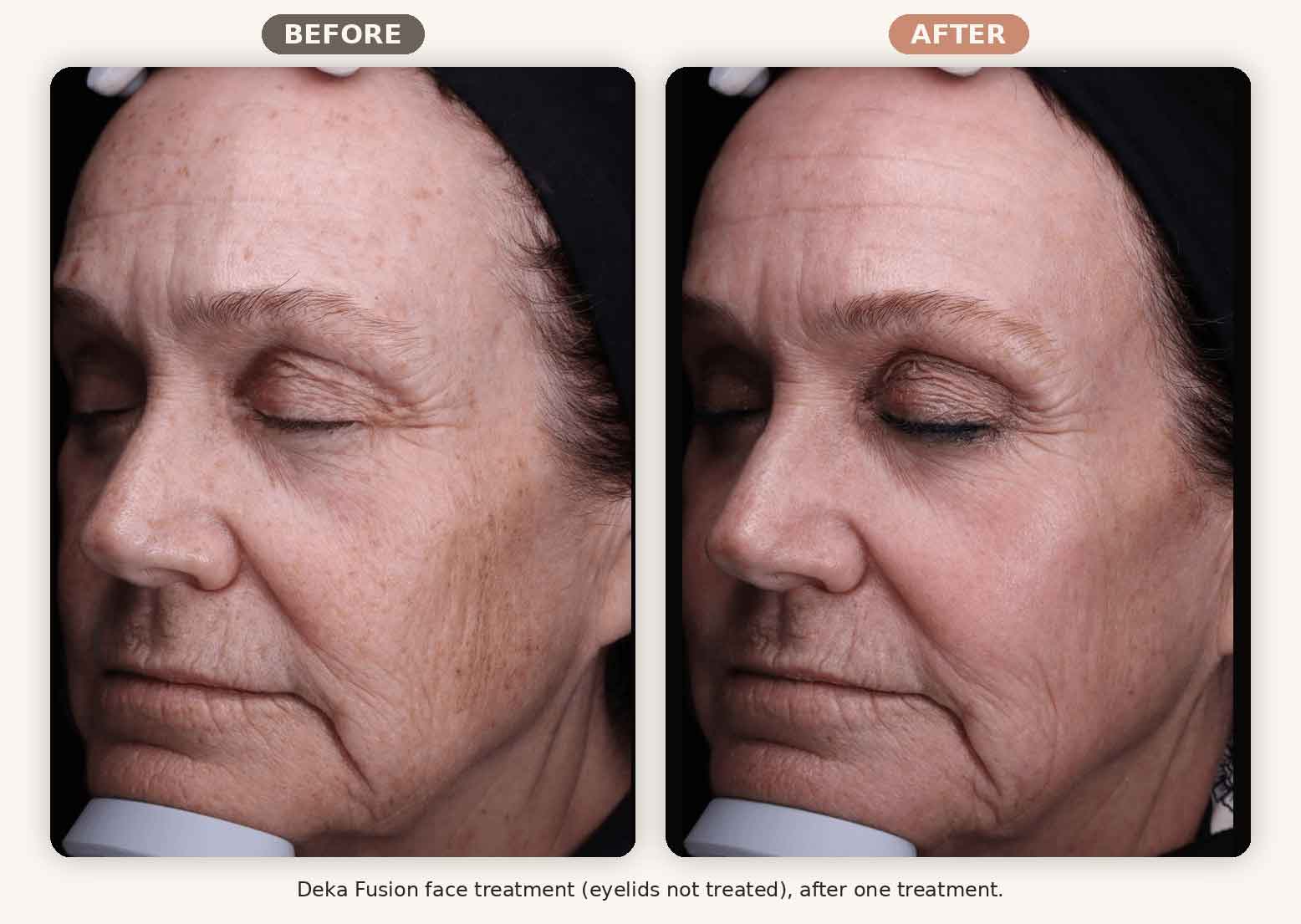Deka Fusion before and after showing reduced pigment, texture, and lines, full face, one treatment, Renew MedSpa Eagan MN