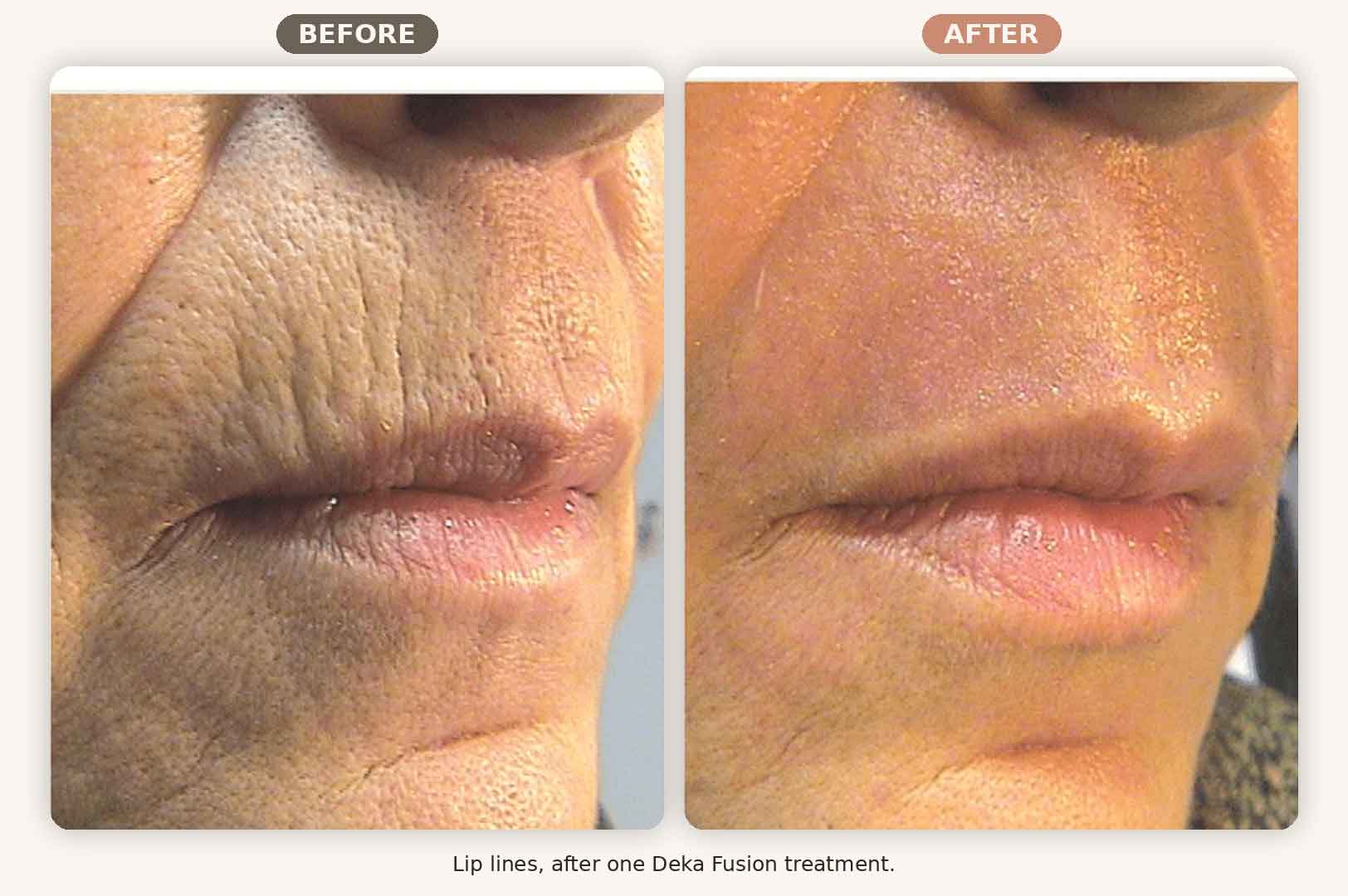 Deka Fusion before and after lip and mouth wrinkles, one treatment, Renew MedSpa Eagan MN