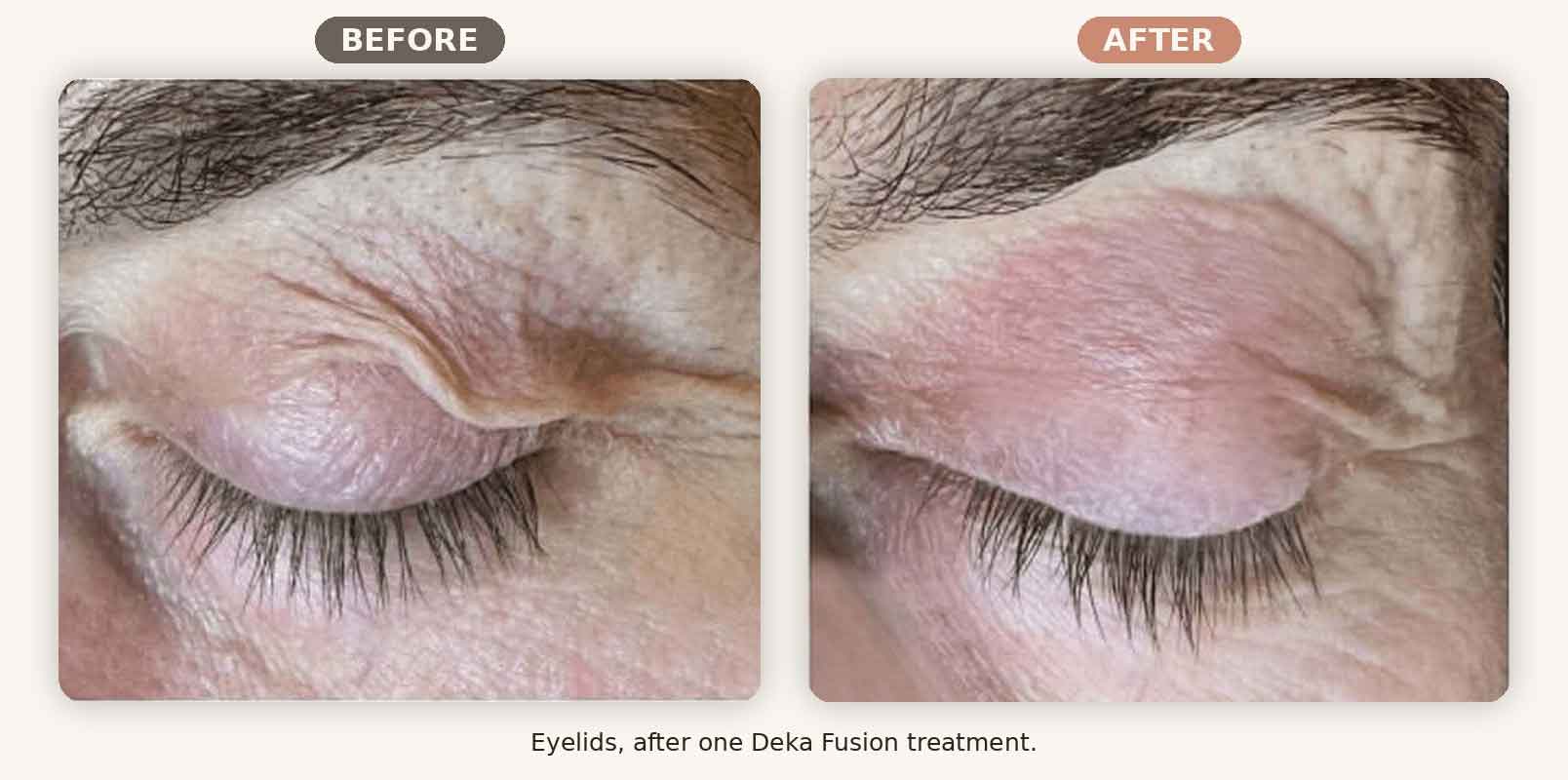 Deka Fusion before and after eyelid skin tightening, one treatment, Renew MedSpa Eagan MN