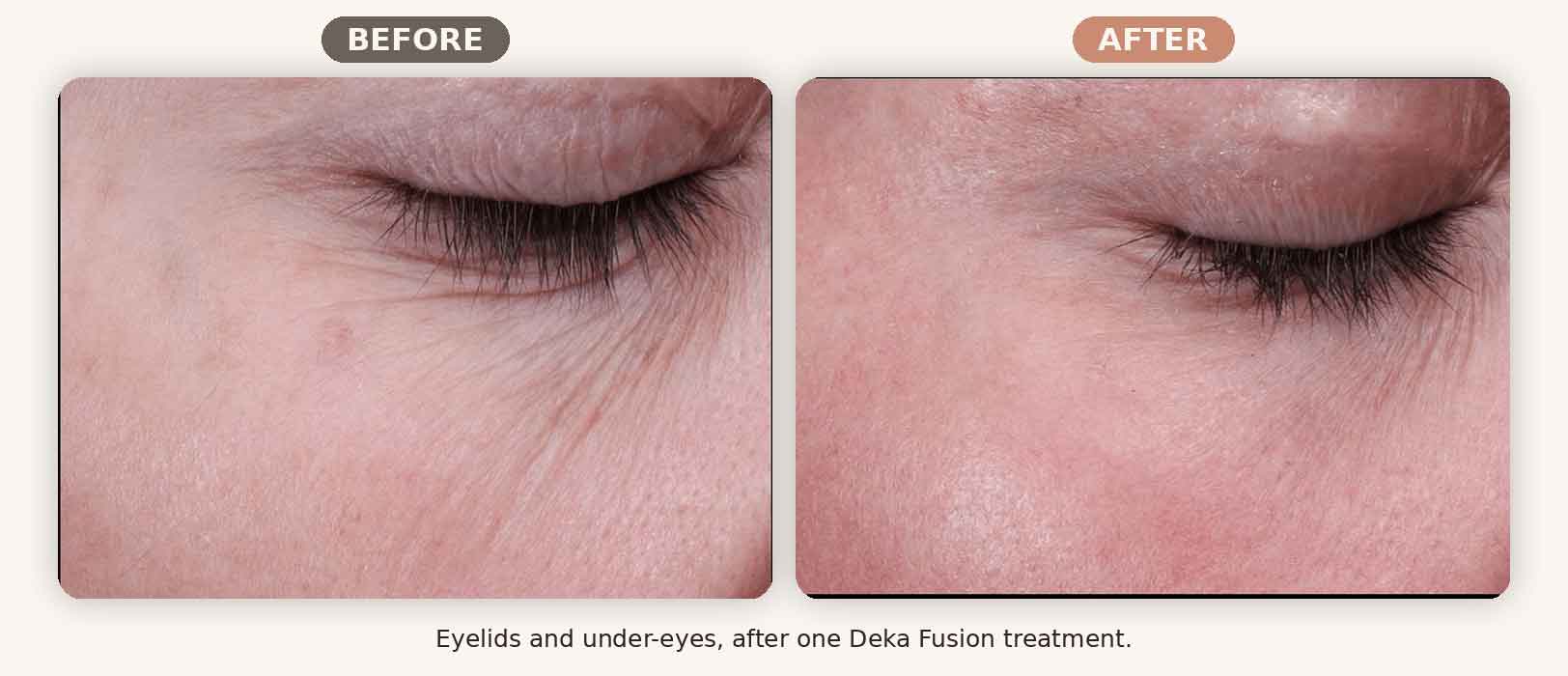 Deka Fusion before and after eyelid and under-eye fine lines, one treatment, Renew MedSpa Eagan MN