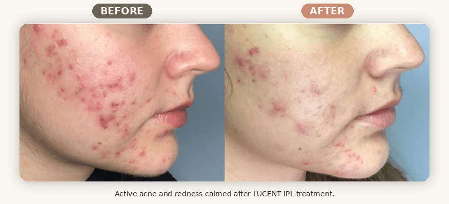 Before and after LUCENT IPL treatment showing calmer acne and reduced redness at Renew MedSpa in Eagan, MN