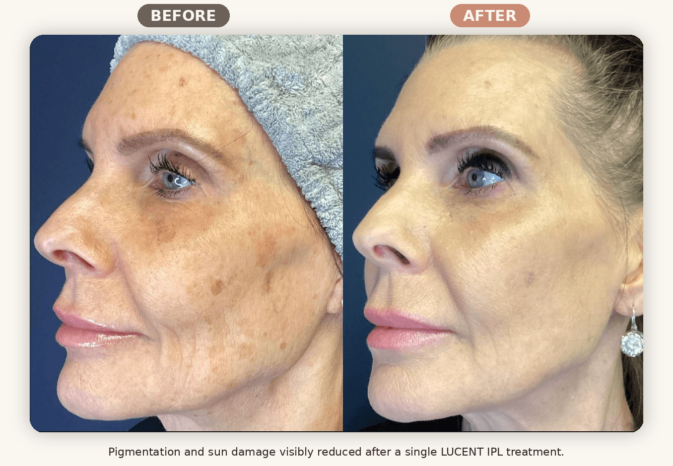 Before and after IPL photofacial showing reduced pigmentation and sun damage at Renew MedSpa in Eagan, MN