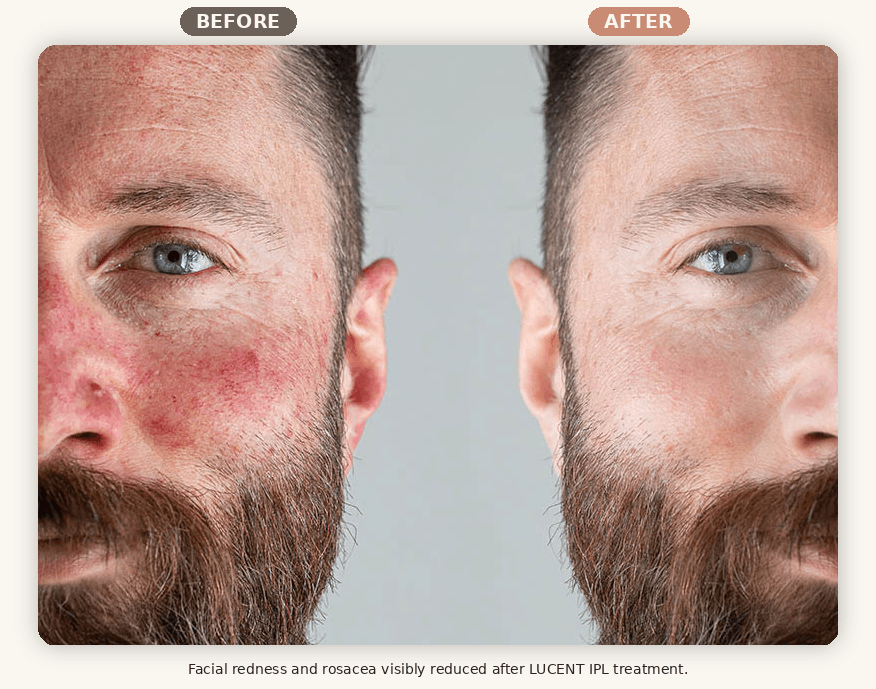 Before and after LUCENT IPL treatment showing reduced facial redness and rosacea at Renew MedSpa in Eagan, MN