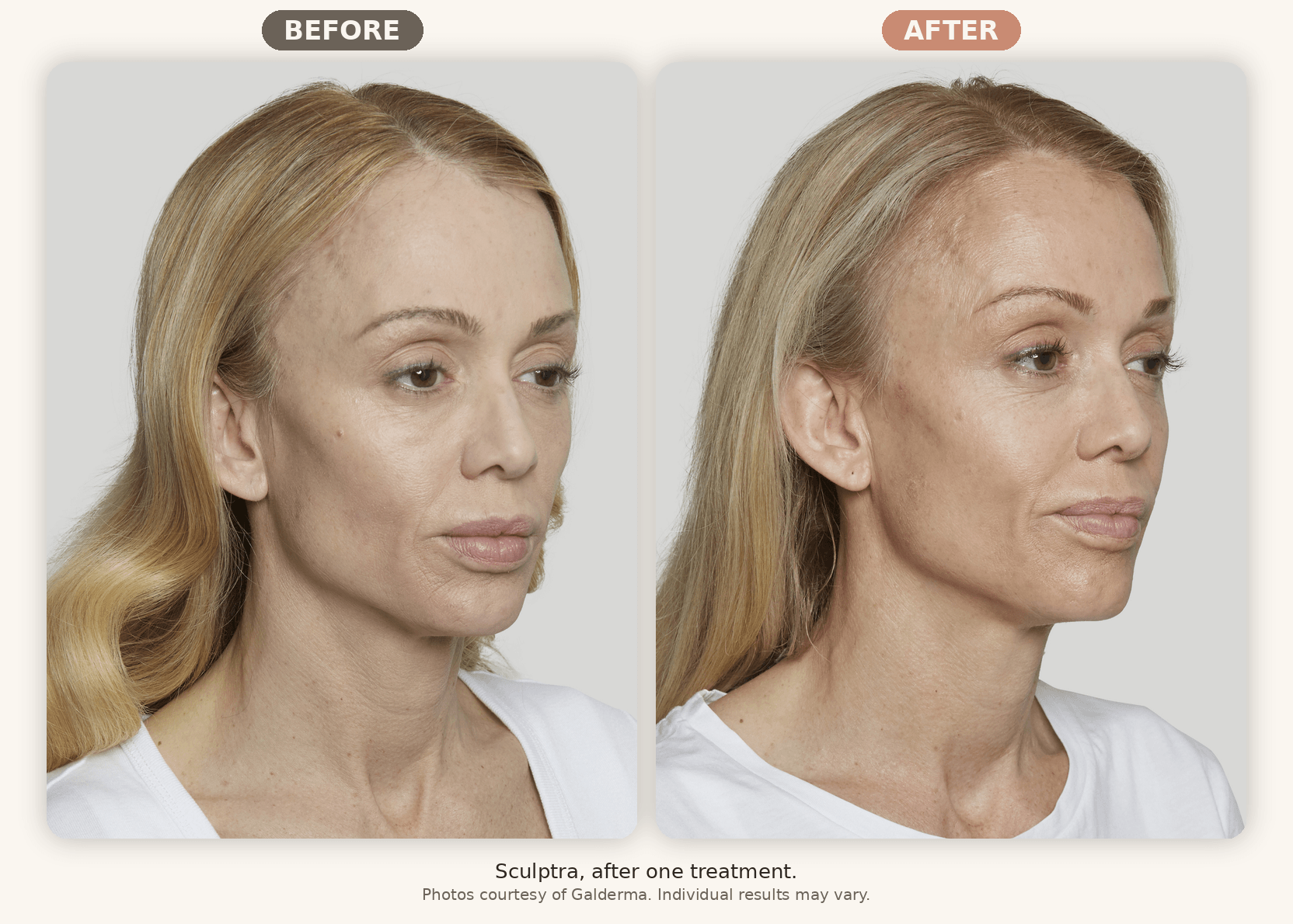 Sculptra before and after one treatment showing improved facial volume and skin quality, Renew MedSpa Eagan MN