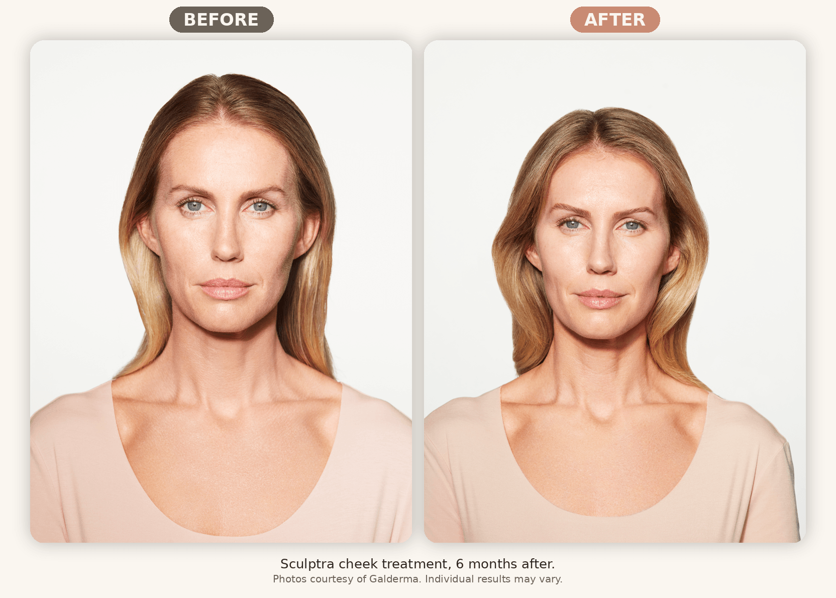 Sculptra before and after showing restored cheek volume at six months, Renew MedSpa Eagan MN