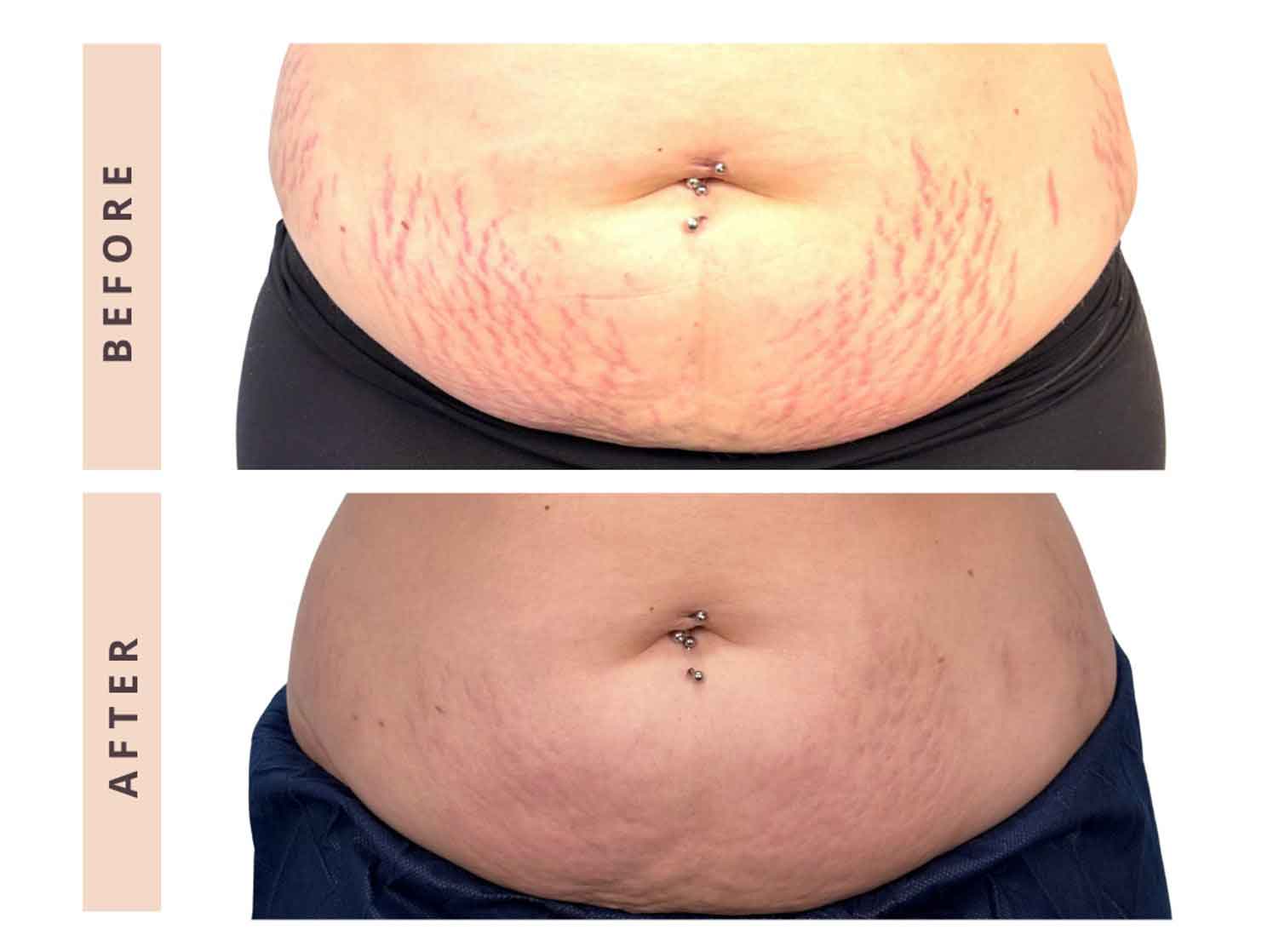 Before and after CO2 laser stretch mark treatment on the abdomen, showing softened, more even skin