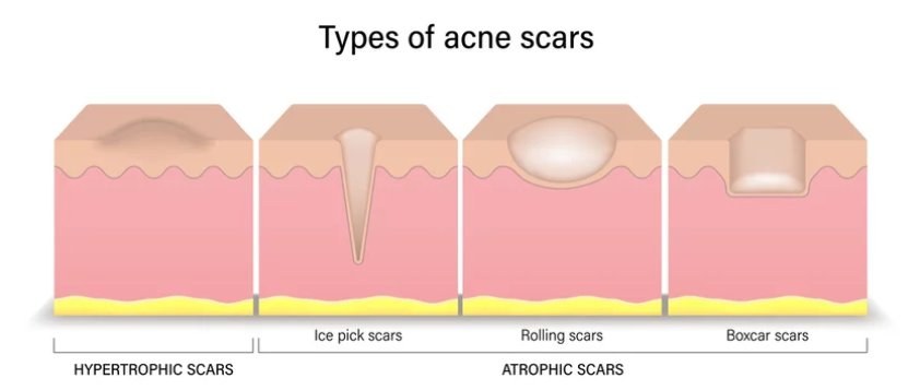 Diagram showing the types of acne scars in cross-section: hypertrophic, and the atrophic types ice pick, rolling, and boxcar scars
