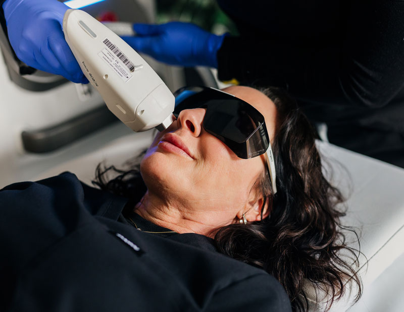 Laser skin treatment being performed at Renew MedSpa in Eagan, MN, with the patient wearing protective eyewear
