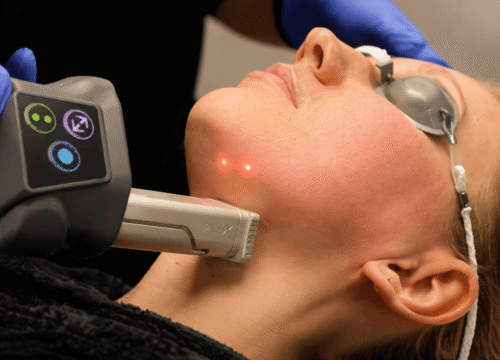 What to Expect After a CO2 Fractional Laser Treatment, and When