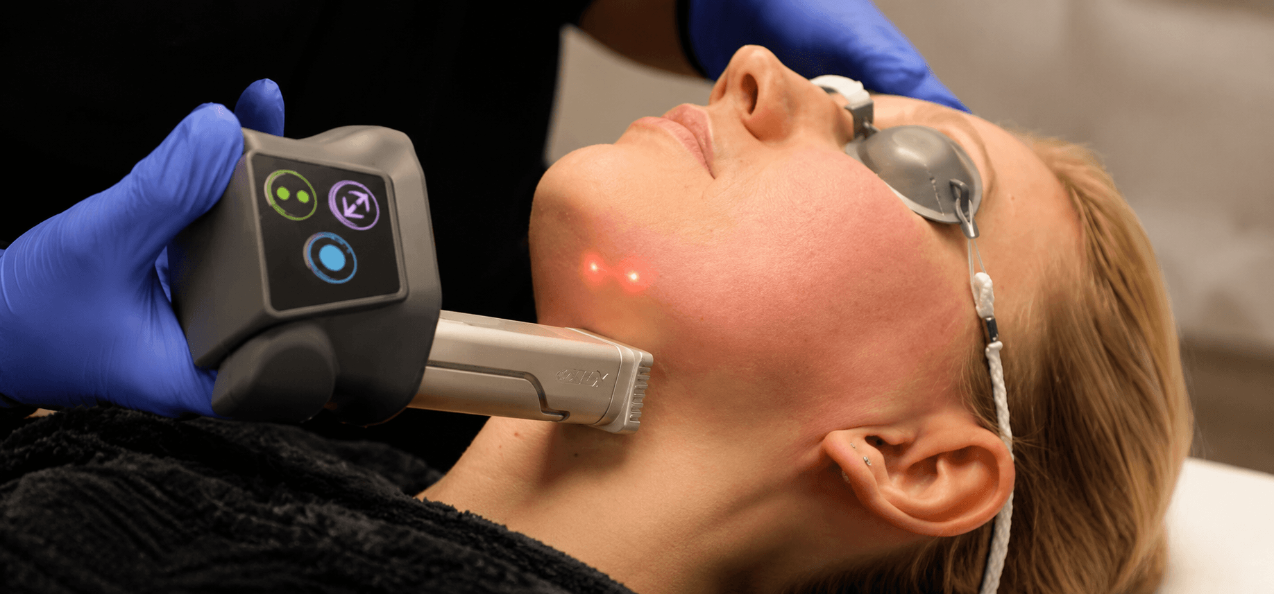 What to Expect After a CO2 Fractional Laser Treatment, and When