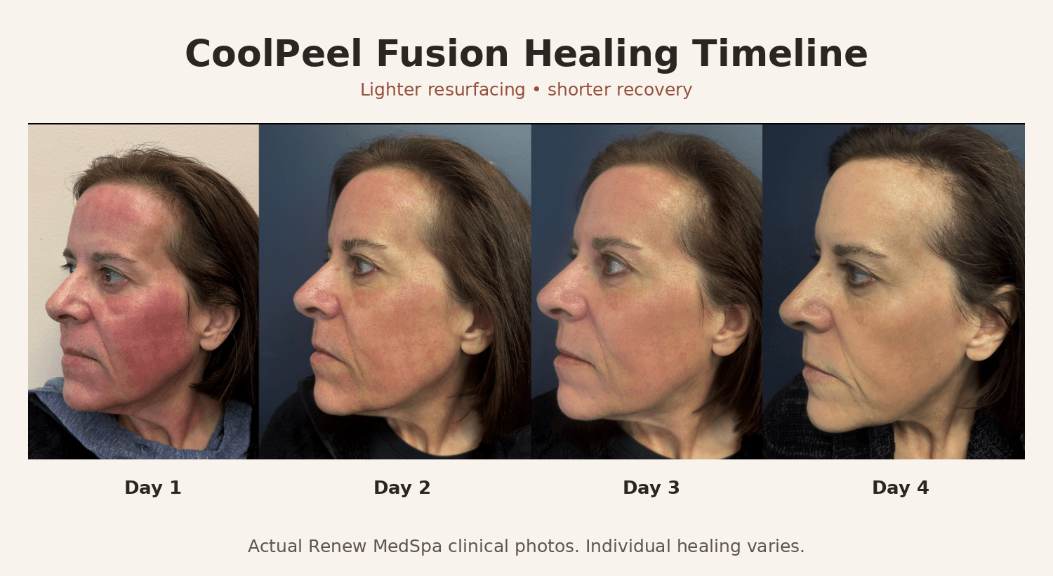 CoolPeel Fusion healing timeline showing days 1, 2, 3 and 4 after treatment at Renew MedSpa